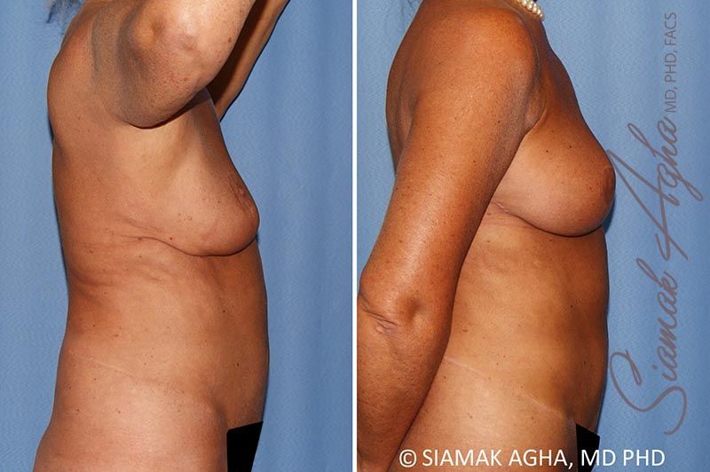 Breast Lift With Augmentation Before & After
