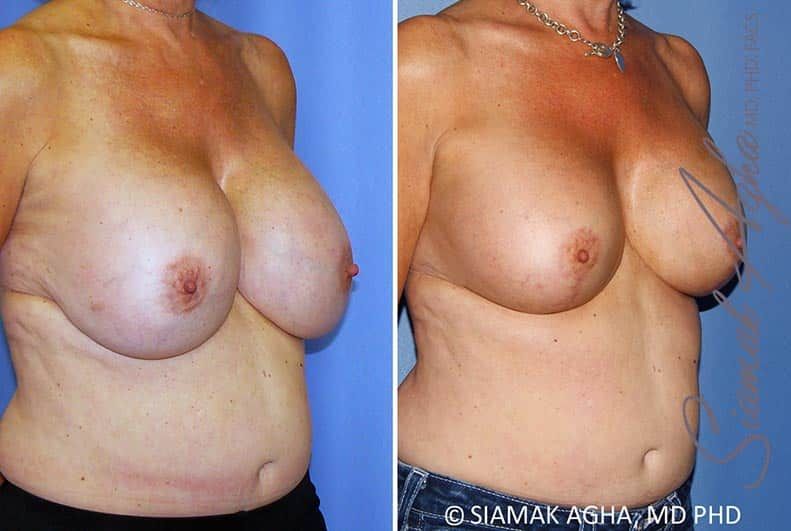 Breast Lift With Augmentation Before & After