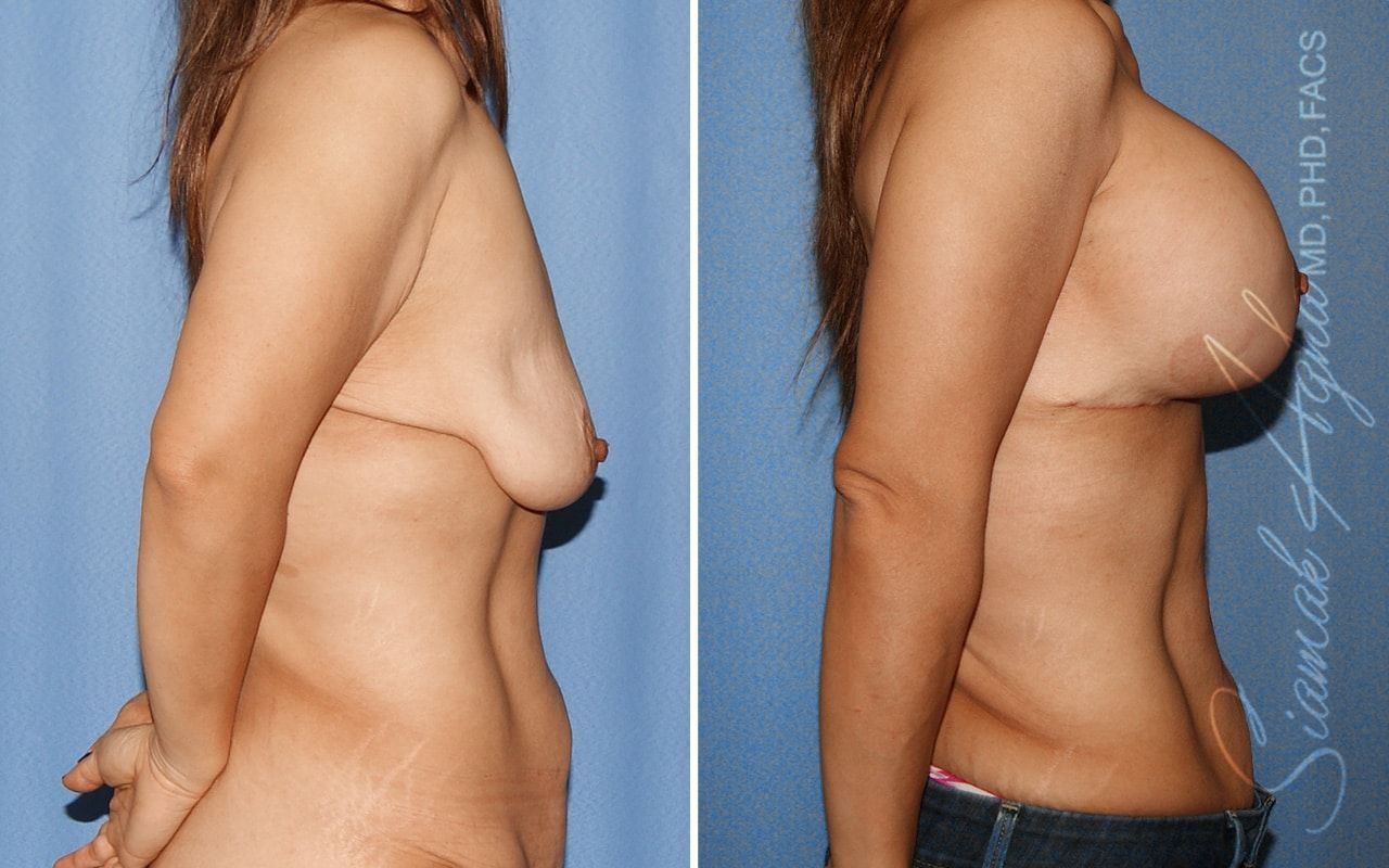 Breast Lift With Augmentation Before & After