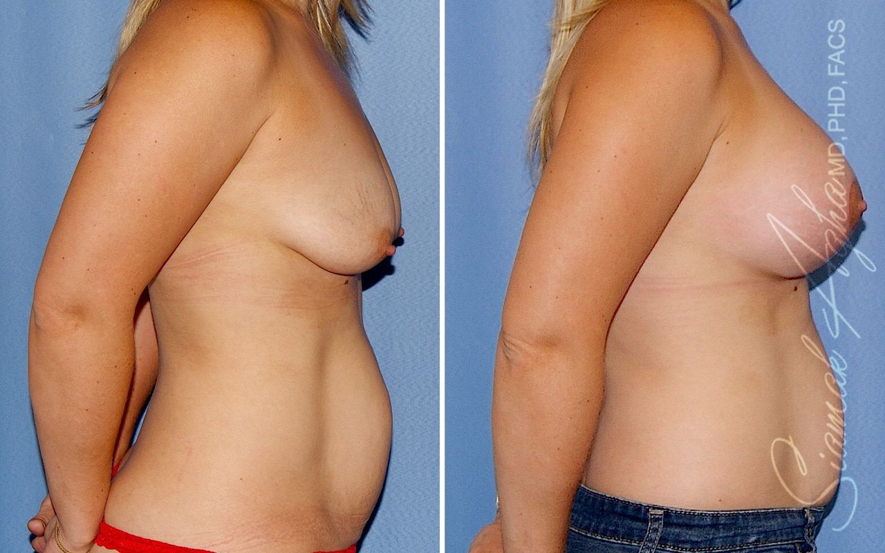 Breast Lift With Augmentation Before & After