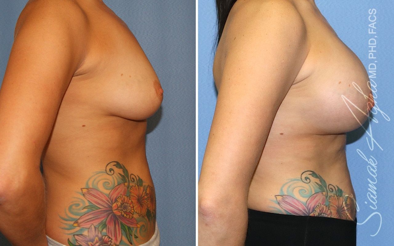 Breast Lift With Augmentation Before & After