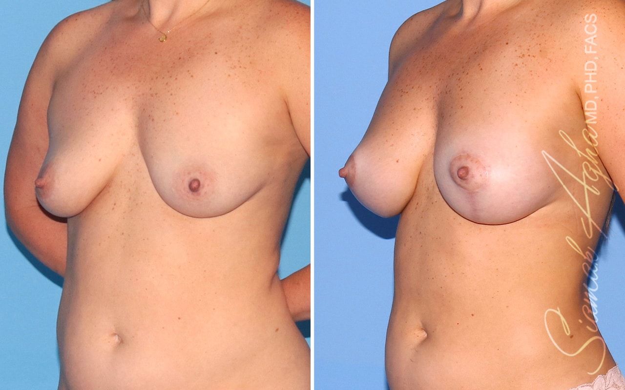 Breast Lift With Augmentation Before & After