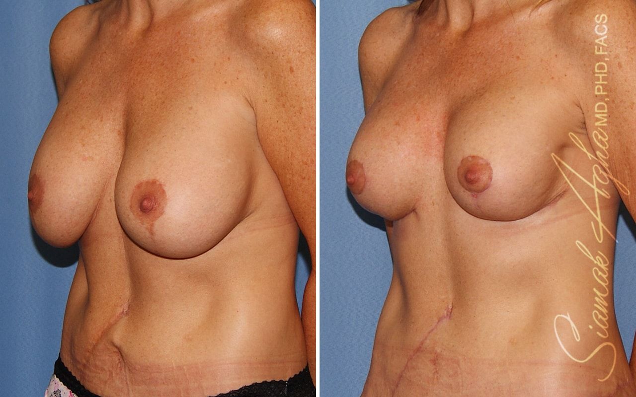 Breast Lift With Augmentation Before & After