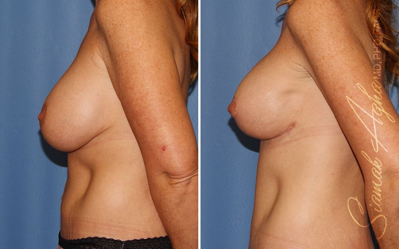 Breast Lift With Augmentation Before & After
