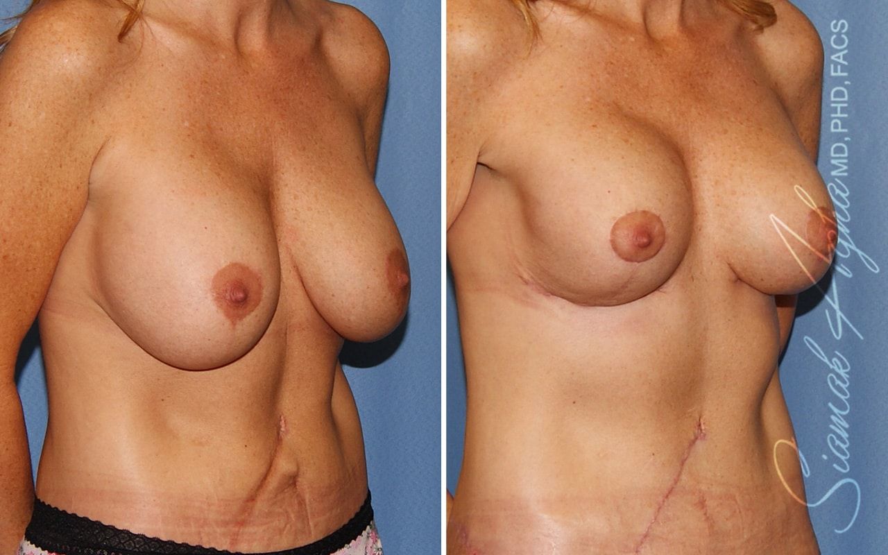 Breast Lift With Augmentation Before & After