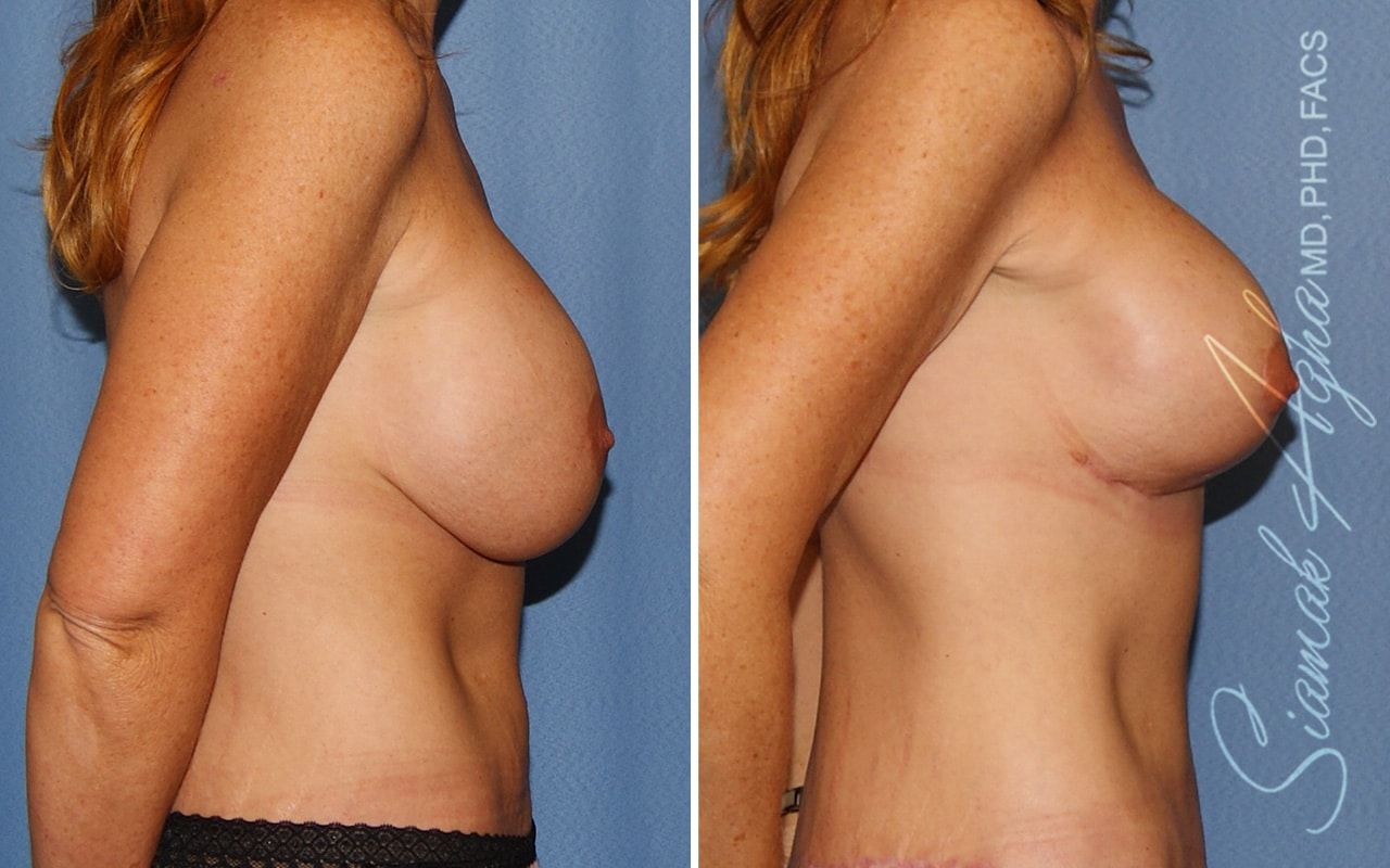 Breast Lift With Augmentation Before & After