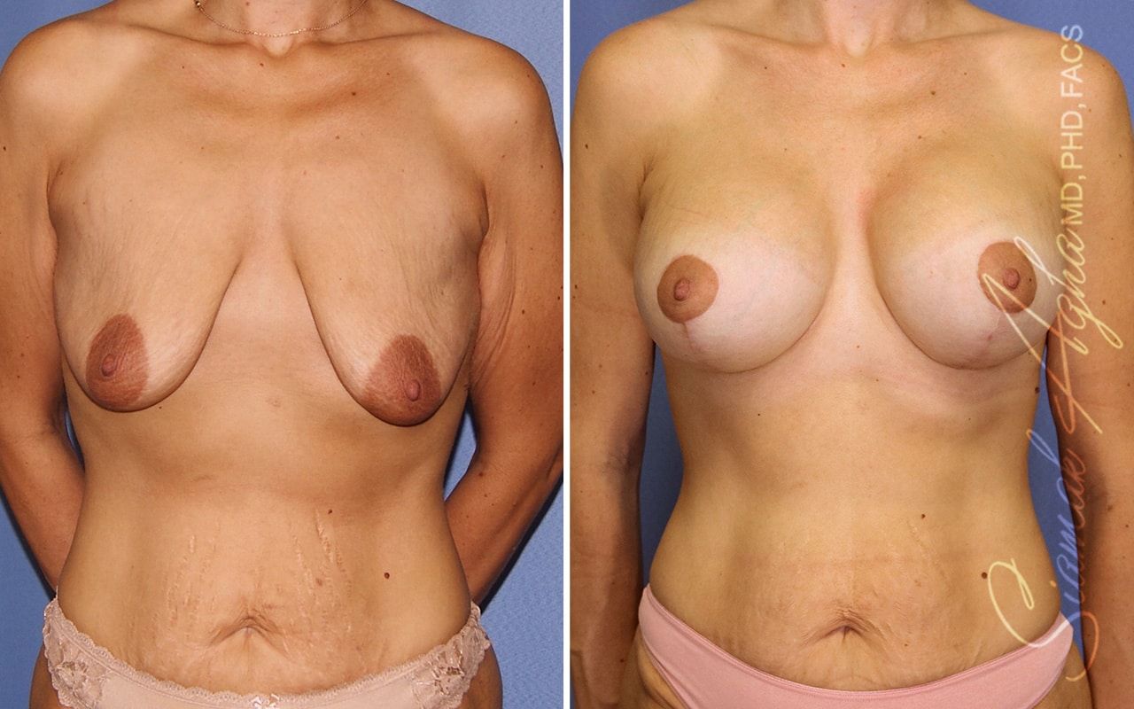 Breast Lift With Augmentation Before & After