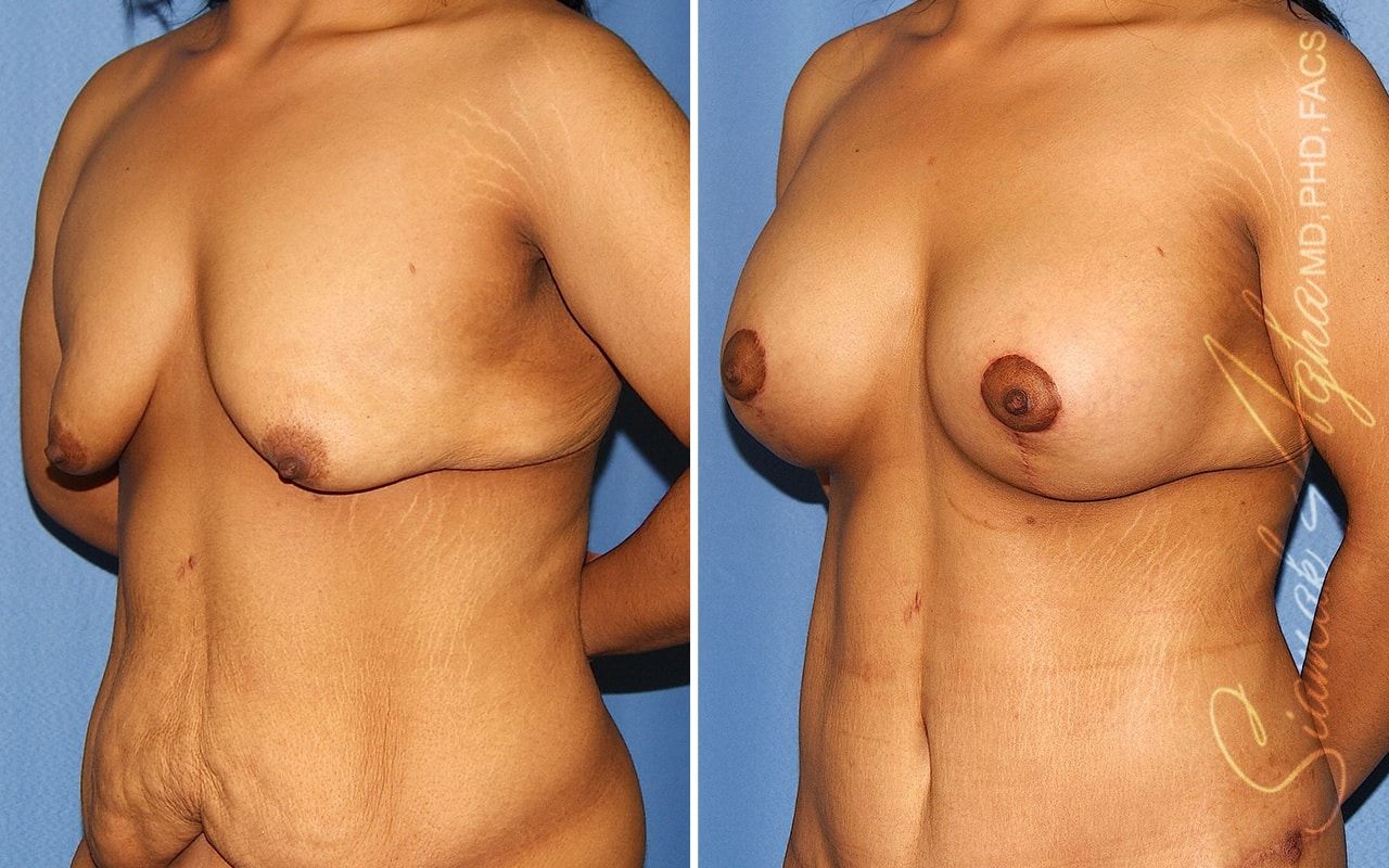 Breast Lift With Augmentation Before & After