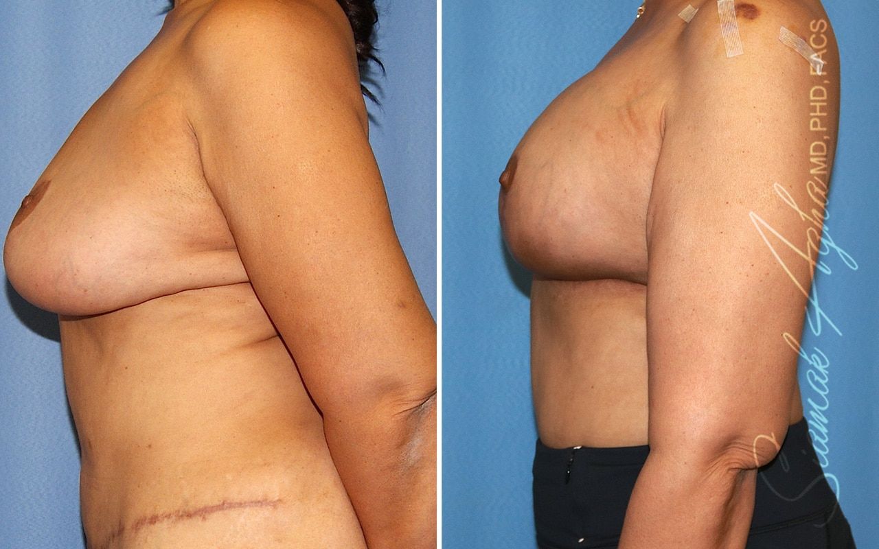 Breast Lift With Augmentation Before & After