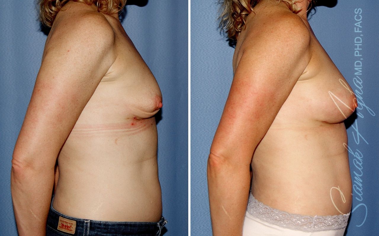 Breast Fat Transfer Before & After