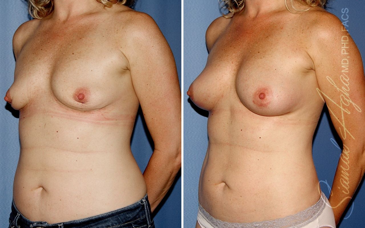 Breast Fat Transfer Before & After