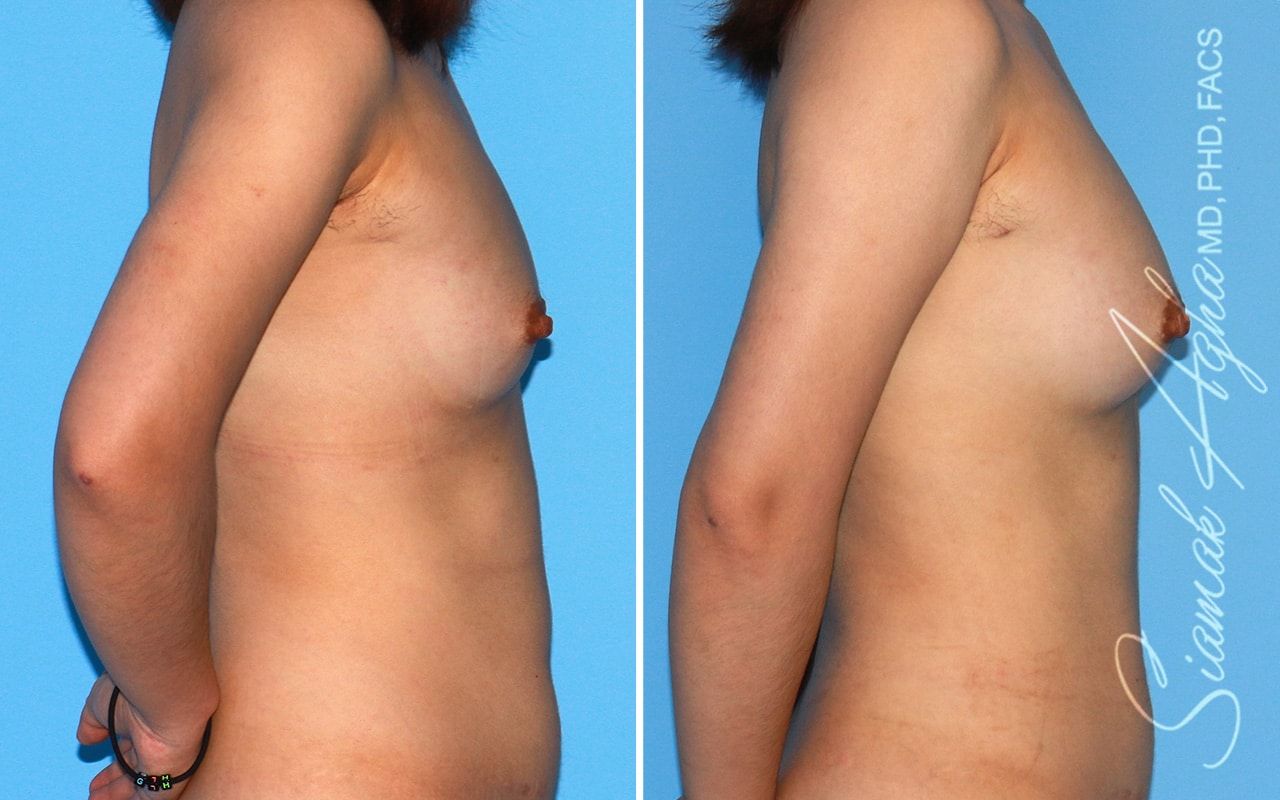 Breast Fat Transfer Before & After
