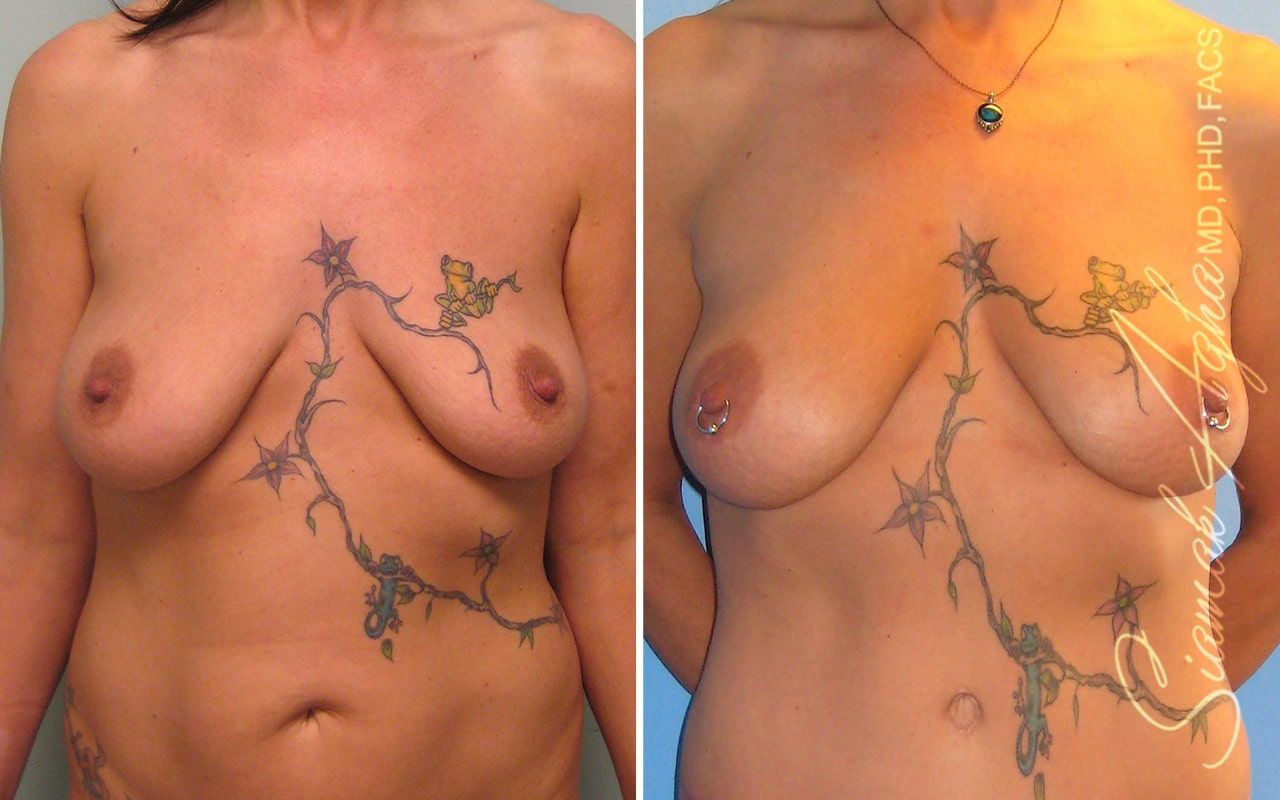 Breast Fat Transfer Before & After