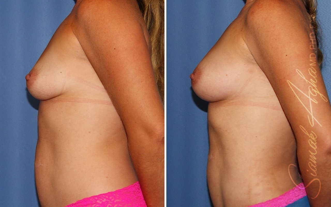 Breast Fat Transfer Before & After
