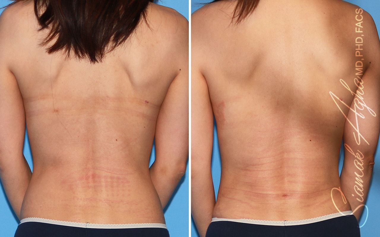 Breast Fat Transfer Before & After