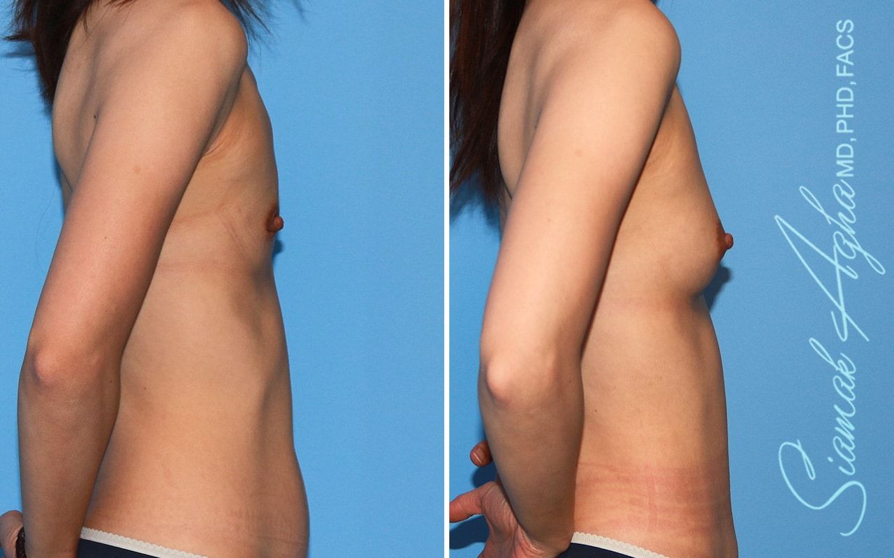 Breast Fat Transfer Before & After