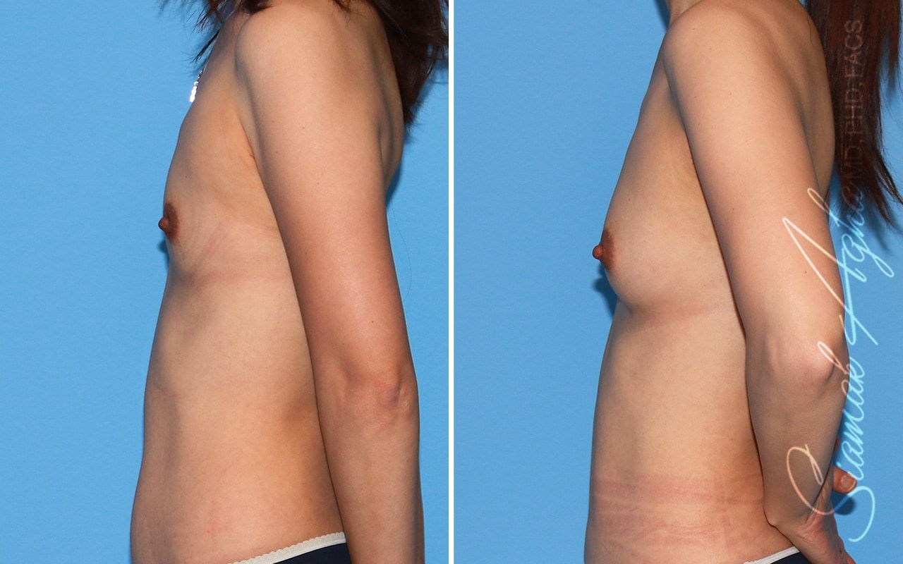 Breast Fat Transfer Before & After