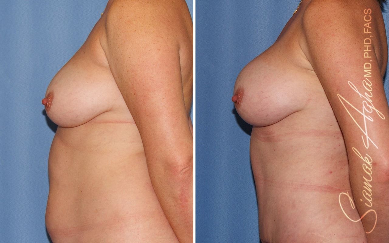 Breast Fat Transfer Before & After
