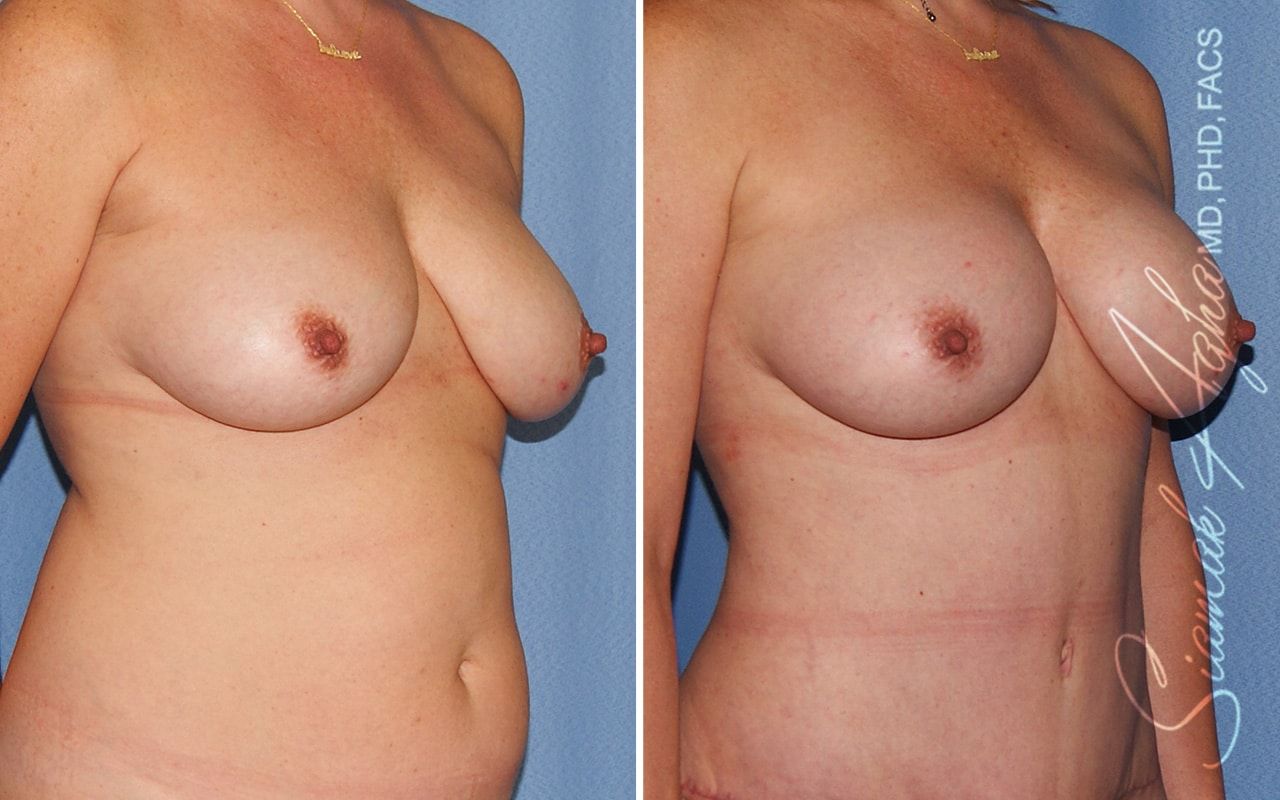 Breast Fat Transfer Before & After