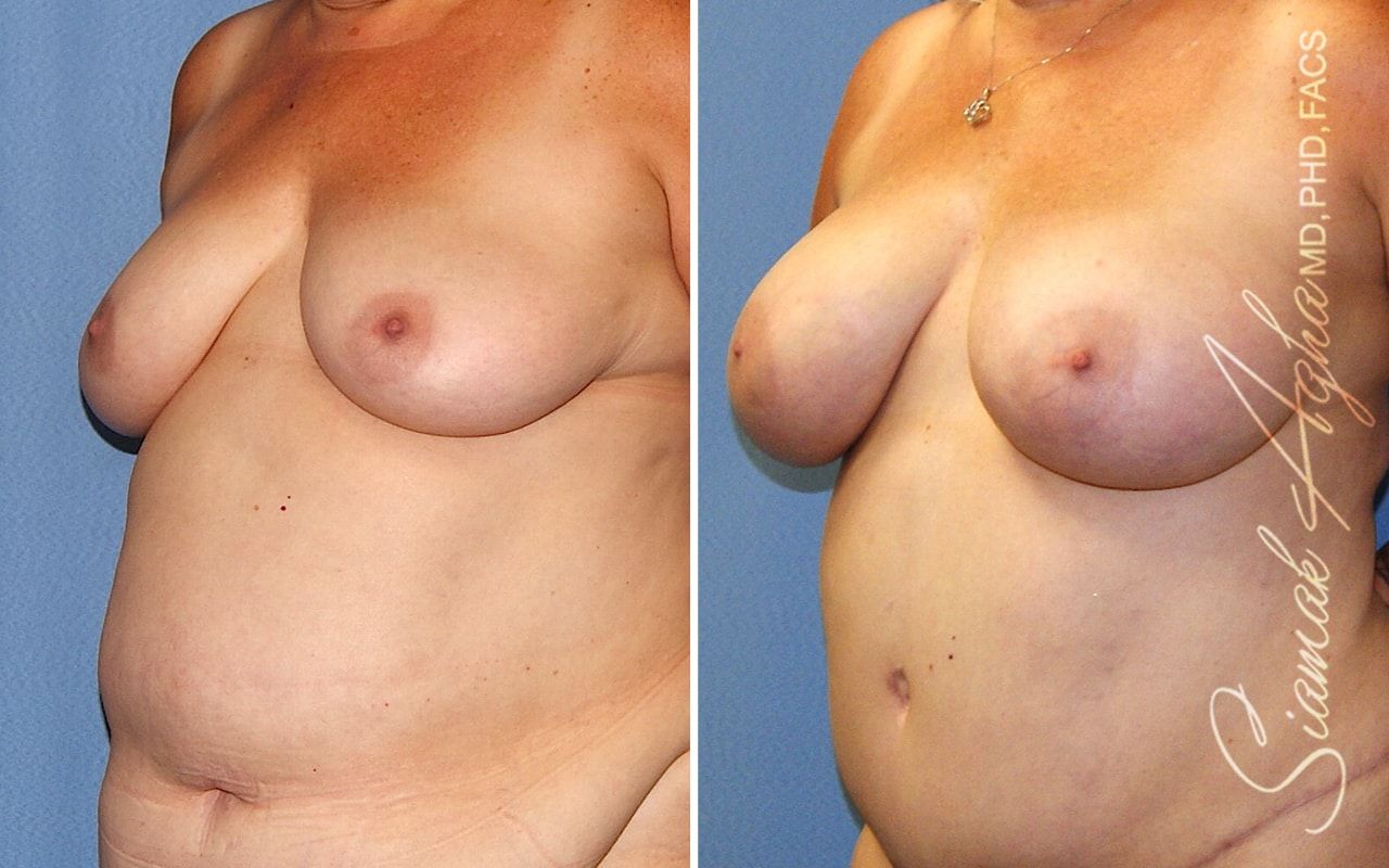 Breast Fat Transfer Before & After