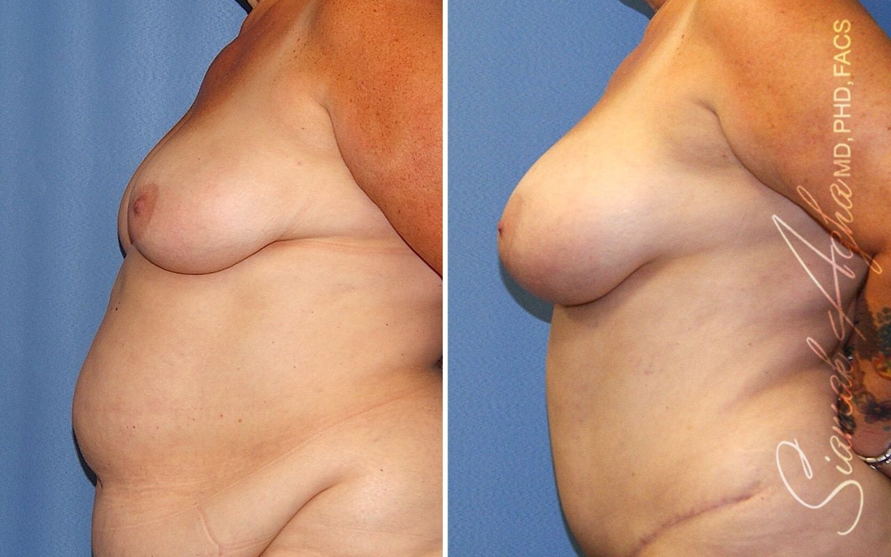 Breast Fat Transfer Before & After
