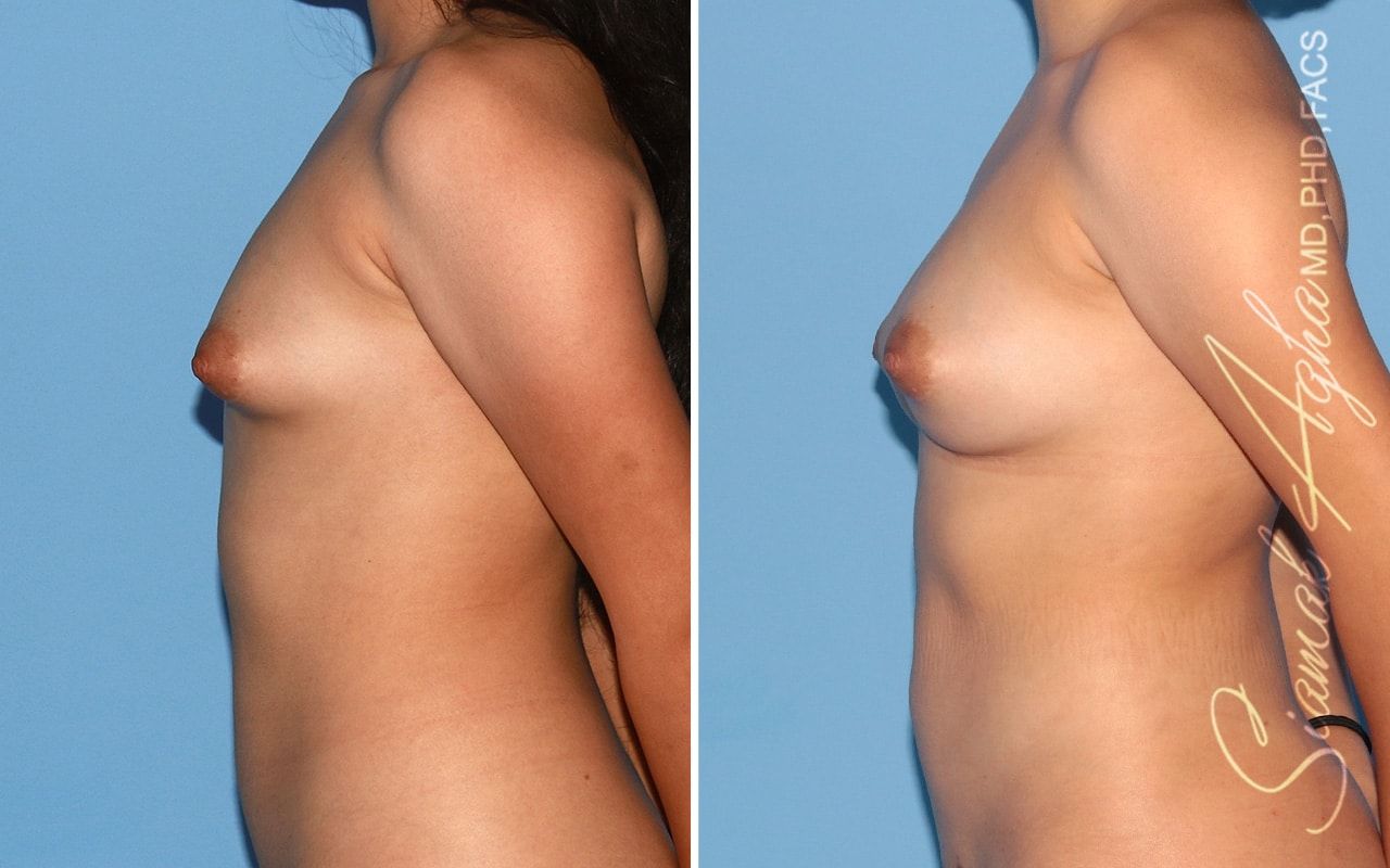 Breast Fat Transfer Before & After