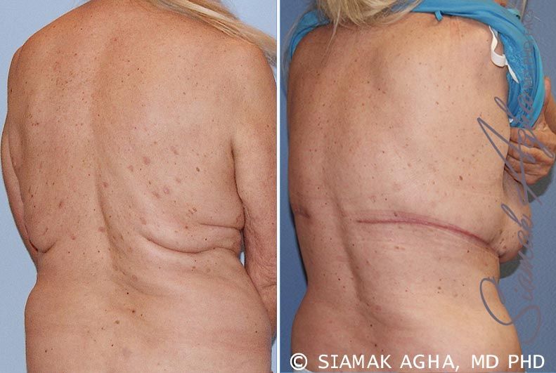 Upper Body Lift Before & After