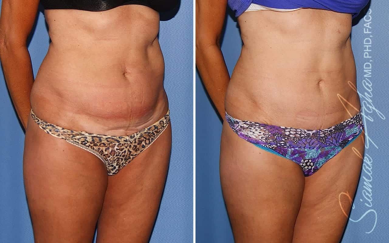 Mini Tummy Tuck Before & After