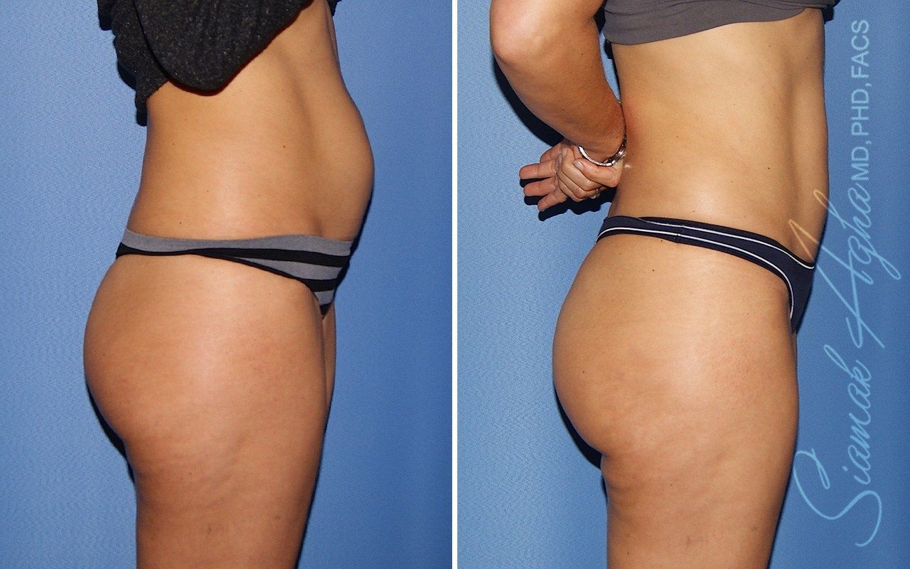 Mini Tummy Tuck Before & After