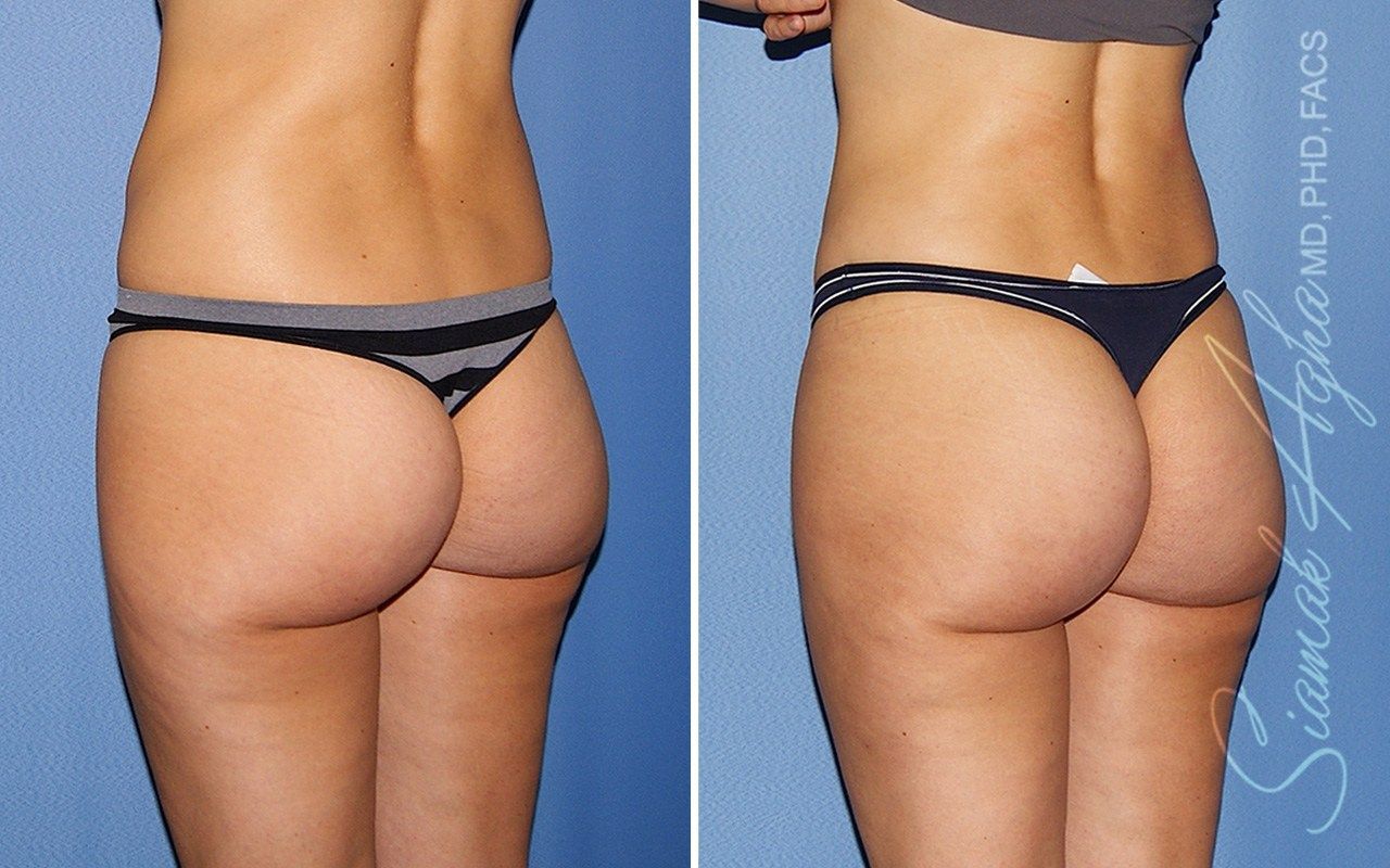 Mini Tummy Tuck Before & After