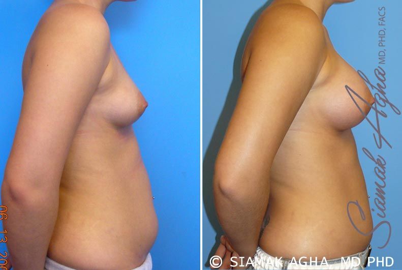 Breast Asymmetry Before & After