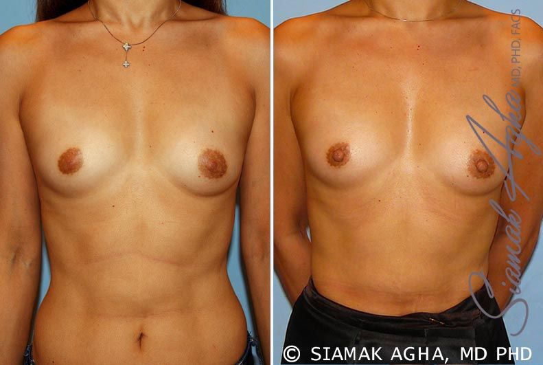 Breast Asymmetry Before & After