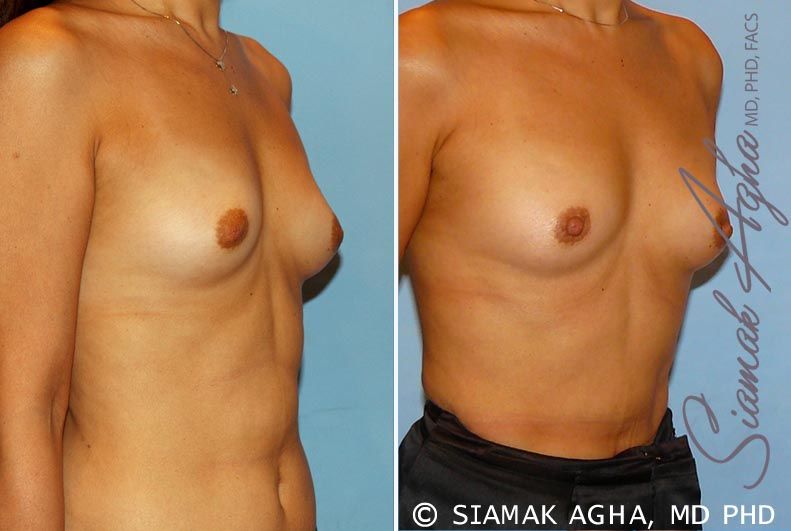 Breast Asymmetry Before & After