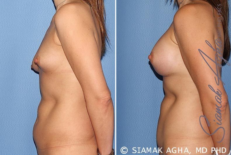 Breast Asymmetry Before & After