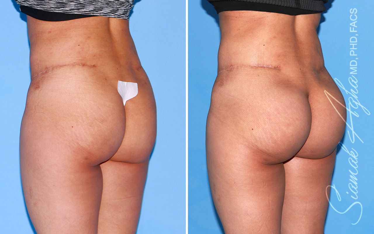 Buttock Implants Before & After
