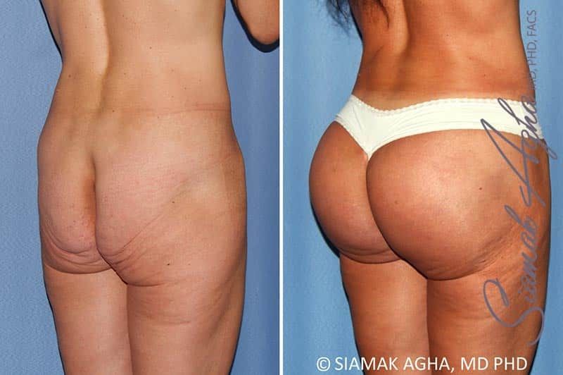 Buttock Implants Before & After